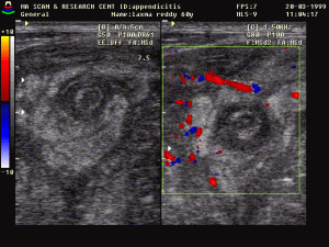 appendicitisultrasoundpic